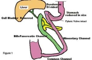 Bowel Obstruction From Scar Tissue Dssurgery