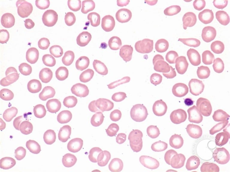 Microcytic Red Blood Cells Dssurgery