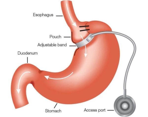 AdjustableGastricBandingDSSurgery DSSurgery